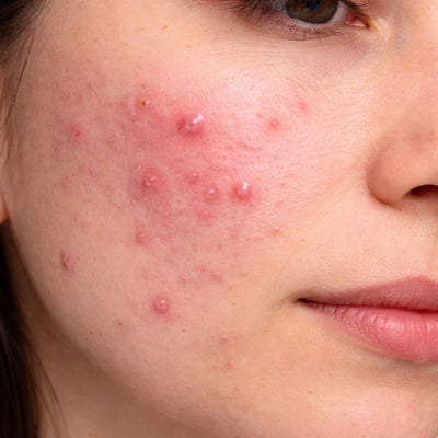 🌿 Acne & Pimples