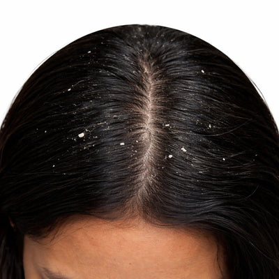 🌿 Dandruff & Scalp Care